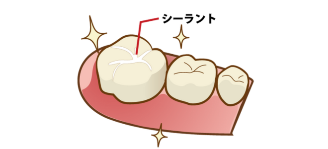 シーラント